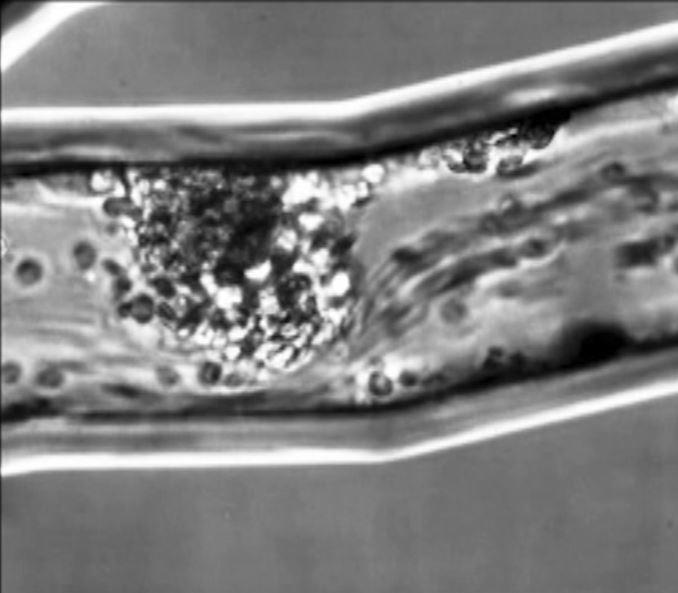 This video demonstrates how an in vitro model of the lung microvasculature, human neutrophils demonstrate swarming behaviour around C. albicans yeast, forming large, persistent clusters and causing partial or complete blockage of blood flow.