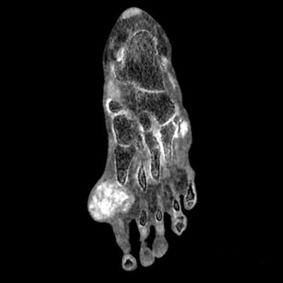 A dual-energy computed tomography image of uric acid crystals. 