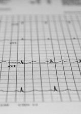 ECG read out